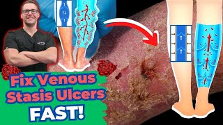 10 Best TIPS for Venous Stasis Ulcers amp Chronic Venous Insufficiency [upl. by Lyrred491]