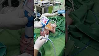 Newborn intubation using UE Miller 0 blade [upl. by Buyse]