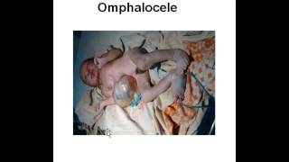 birth defect  omphalocele amp gastroschisis [upl. by Sabanrab]