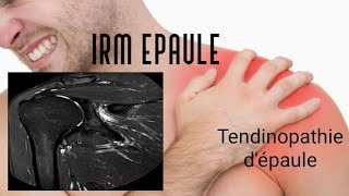 IRM DE L’EPAULE  tendinopathie [upl. by Anaihsat]