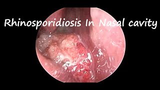 Rhinosporidiosis on Nasal Endoscopy [upl. by Icyac66]