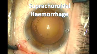 Suprachoroidal Haemorrhage During Cataract Surgery [upl. by Lemieux]