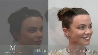 Maria Fowler Hair Transplant Final Result1873 FUT 14 Months [upl. by Lemmor]