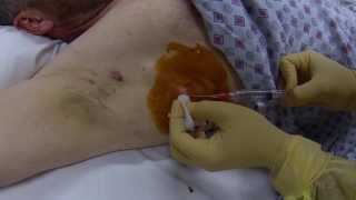 infected cyst drainage procedure [upl. by Alemrac]