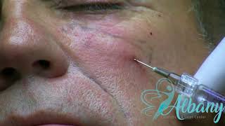 Tear trough filler with microcannula [upl. by Taka]