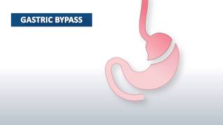 What is gastric bypass surgery  Beaumont Health [upl. by Sajovich]