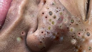 acne blackheads whiteheads removalcystic acne blackhead whitehead removalbig cystic acneext12084 [upl. by Alyek]