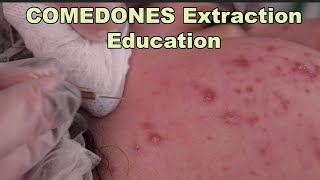 Comedones Extraction Part 1 of the best acne treatment before and after pictures included [upl. by Ellehsar320]