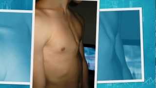 pectus carinatum brace  DIY [upl. by Annua961]