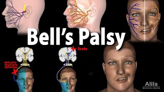 Bells Palsy Pathophysiology Symptoms Diagnosis and Treatment Animation [upl. by Norak]