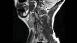 MRI scans brainneck injury abnormal full v2 [upl. by Pulsifer]