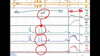 how to interpret cystometry urodynamics [upl. by Wendy571]