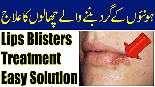 Honton K Chalon Ka Ilaj  Blisters Around Lips Causes [upl. by Asante]