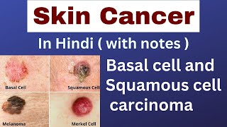 Skin cancer  Squamous cell carcinoma  Basal cell carcinoma  nursing lecture in hindi  msn [upl. by Esnofla]