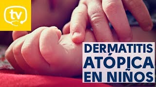 Algunos datos sobre la dermatitis atópica en los niños [upl. by Salomon]