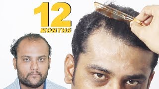 Hair Transplant 12 Months Postop  Medispa Jaipur Delhi  Ahmedabad India  Dr Suneet Soni [upl. by Annuahsal]