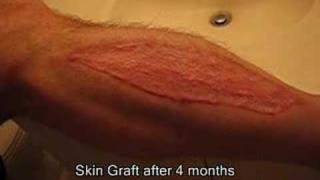 Part 4  Brads Surgery 4 months after graftb [upl. by Laflam]