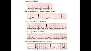 ECG course AV blocks Dr Sherif Altoukhy [upl. by Ploch]