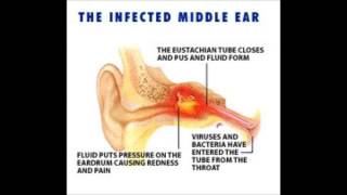 Conductive Hearing Loss Example [upl. by Anuat78]