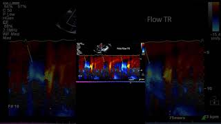 Only 2 out of 4 Unguarded tricuspid orifice absent tricuspid leaflets leads to free flow TR [upl. by Nahtan669]