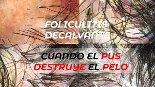 FOLICULITIS DECALVANTE cuando el PUS destruye el PELO [upl. by Rexana32]