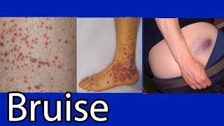 Bruise Hematoma blue spots on skin causes and treatment [upl. by Eahs442]