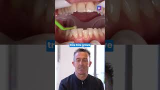 Orthodontie lingual et vestibulaire  collage en technique mixte 🦷 [upl. by Portugal]