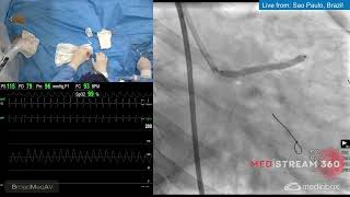 FFR and IVUSGuided Single Stent PCI From LM to Ostial LAD [upl. by Nodearb]