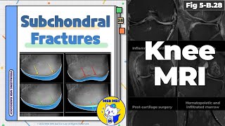 Fig 5B28 Four Types of Subchondral Insufficiency Fractures [upl. by Kubetz]