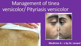 Management of tinea versicolor Pityriasis versicolor [upl. by Geiger]