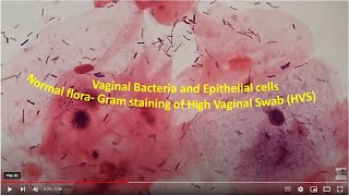 Vaginal Normal Flora in Gram staining of High Vaginal Swab HVS [upl. by Renferd]