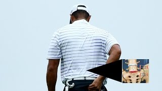 A look at Tiger Woods L5S1 spinal fusion back surgery [upl. by Valentino]