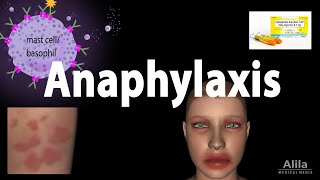 Anaphylaxis Animation [upl. by Reynold]