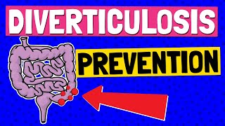 Diverticulosis TREATMENT amp PREVENTION 🍴 Which FOODS to EAT and AVOID [upl. by Resarf]