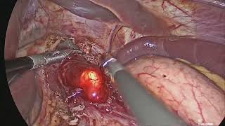 Laproscopic Heller’s myotomywith Toupet Fundoplication and Intraoperative UGI Endoscopy [upl. by King690]