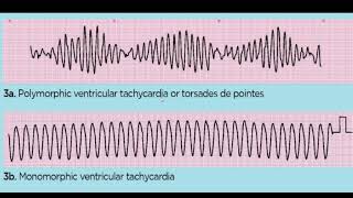 TORSADES DE POINTES 4TH YR [upl. by Jamill774]