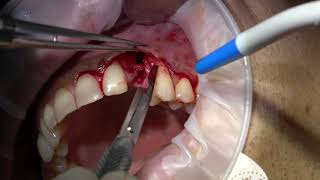 immidiate implant loading with computer guided placement and soft tissue graft [upl. by Elleunamme163]