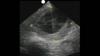 How to Aorta Ultrasound  Aneurysms Case Study [upl. by Fallon995]