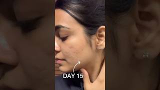 TRETINOIN for Acne Scars 30 DAYS shorts [upl. by Areikahs]