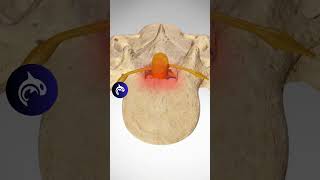 See how Lumbar Stenosis affects the Spine  3D Animation lumbarspinalstenosis backpain backpain [upl. by Indira]