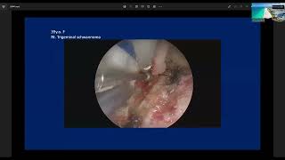 Endoscopic Kayhole Anterior Petrosal Approach to Petrous Lesions  Professor Takeo Goto [upl. by Odrarebe]