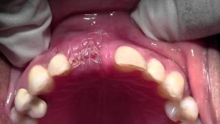 Implant Placement with Bone Grafting 8 Site Mineross amp dPTFE 1 Week postop [upl. by Wildermuth]