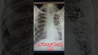 chest Xray yah kaun si bimari hai youtuber youtubeshort doctor [upl. by Costa]