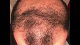 6 months using minoxidil  Rogaine 5 Before amp After results [upl. by Otrebtuc]