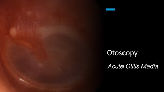 Acute Otitis Media Otoscopy [upl. by Eniruam]