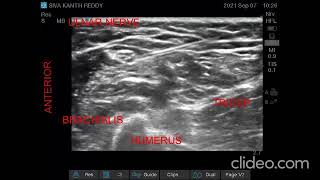 ULNAR NERVE BLOCK ABOVE ELBOW  ULTRASOUND GUIDED [upl. by Diandre]