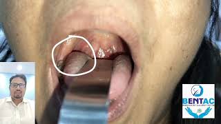 information about tonsillolith and tonsil stone removal in hindi [upl. by Emixam]