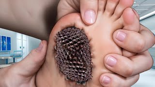 ASMR Aaise Kido Se Dur Hi Raho  ASMR Removal Extras Bulk Infected Toe  ASMR Beduk Sap [upl. by Brest188]