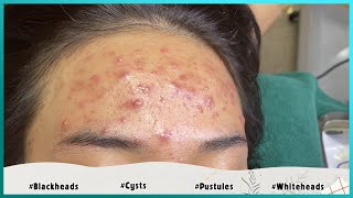 Big Cystic Acne Blackheads Extraction Blackheads amp Milia Whiteheads Removal Pimple Popping [upl. by Iahcedrom]