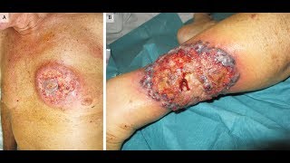 Pyoderma Gangränosum bei Colitis ulcerosa [upl. by Amaral]